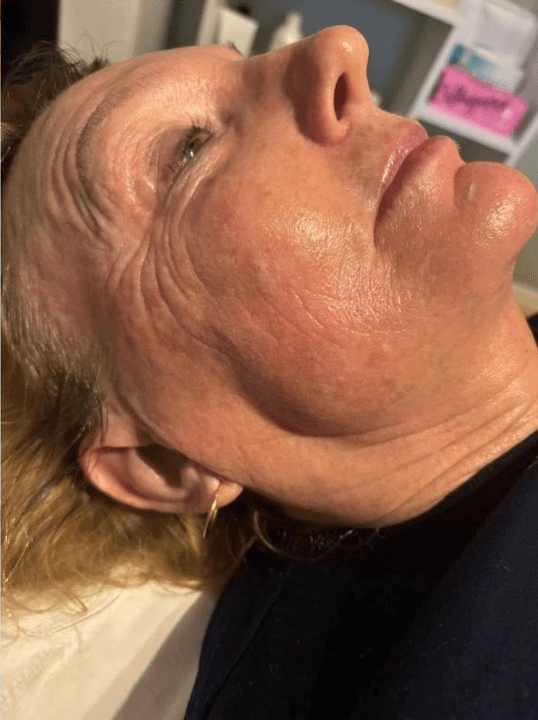 SkinBase Collagen Lift — after treatment