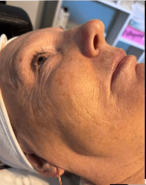 SkinBase Collagen Lift — before treatment