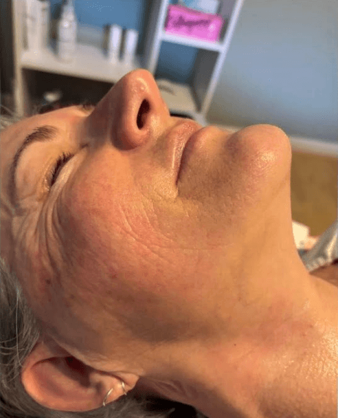 SkinBase Collagen Lift — after treatment