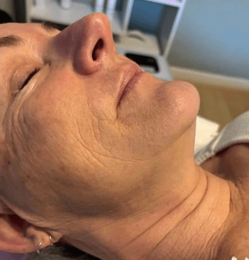 SkinBase Collagen Lift — before treatment