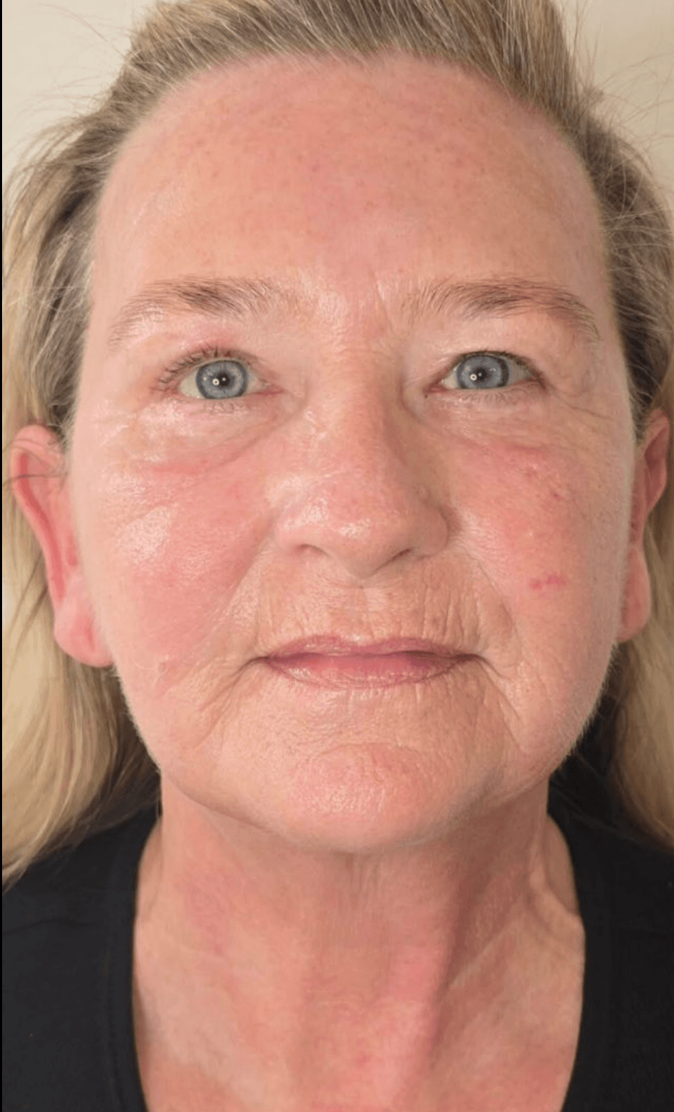 Collagen Lift — Course of 6 (Face & Neck) — after treatment