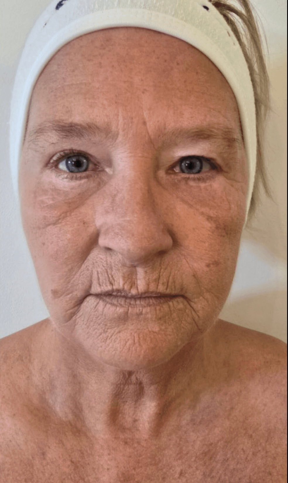 Collagen Lift — Course of 6 (Face & Neck) — before treatment