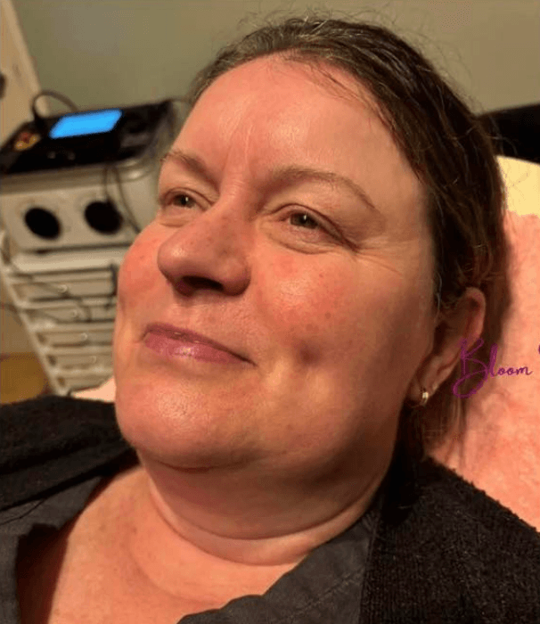 Hydro Facial — after treatment