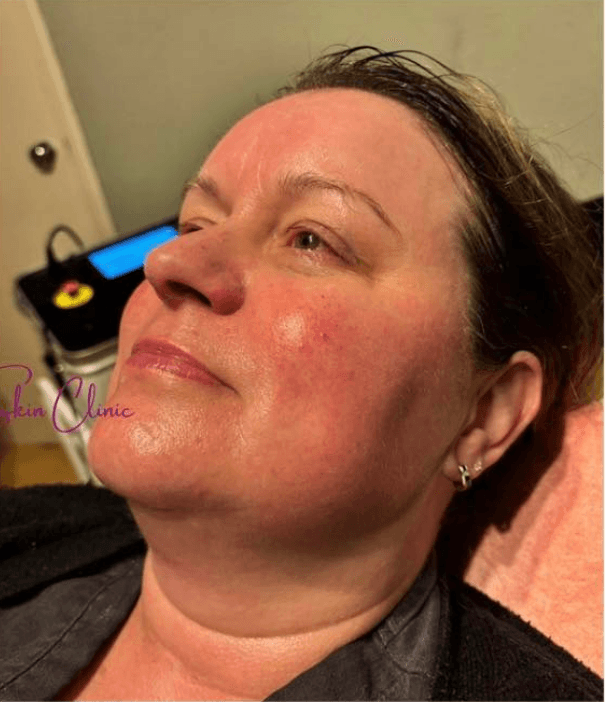Hydro Facial — before treatment